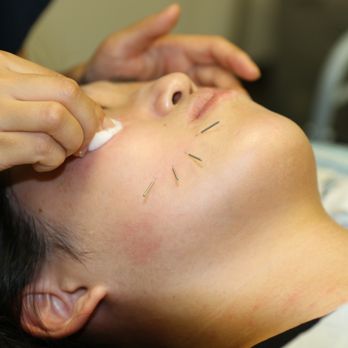 Sanare Acupuncture Image
